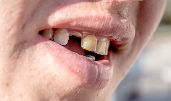 Replace Missing Teeth With Dental Bridges